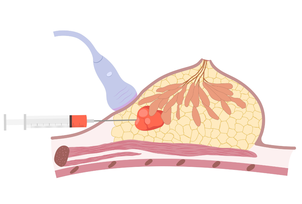 Προεγχειρητική βιοψία μαστού (Core biopsy)